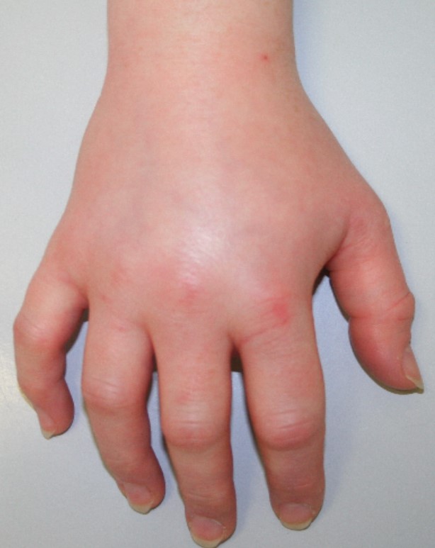 Akutes Ödem des Handrückens bei einer Patientin mit einem Hereditären Angioödem Typ II Akutes Ödem des Handrückens bei einer Patientin mit einem Hereditären Angioödem Typ II